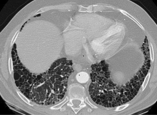 This transverse high-resolution computed tomography (HRCT) axial scan of the chest demonstrates a classic usual interstitial pneumonia (UIP) pattern, frequently associated with fibrotic interstitial lung disease (fILD) in patients with rheumatoid arthritis. The imaging highlights significant architectural distortion characterized by extensive honeycombing, which appears as clustered cystic air spaces with thick, well-defined walls. These abnormalities show a clear basal and subpleural predominance, extending toward the lung periphery while relatively sparing the more central parenchymal regions. Prominent reticular opacities are intermixed with the cystic changes, indicating chronic pulmonary fibrosis. This visual presentation is key for differentiating insidious rheumatoid arthritis-related fibrotic lung disease from acute inflammatory conditions like methotrexate-induced pneumonitis, which typically presents with diffuse ground-glass opacities rather than the honeycombing and structural remodeling shown here.