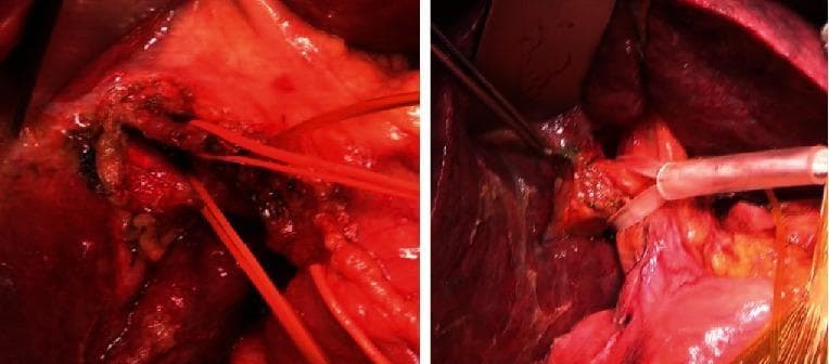 This clinical intraoperative photograph set demonstrates two different surgical techniques for managing the right Glissonean pedicle during liver resection. The left image illustrates the intrafascial approach, characterized by the meticulous dissection and isolation of individual vascular and biliary components within the Glissonean capsule. Several red vessel loops are seen encircling the dissected structures for traction and identification. In contrast, the right image depicts an extrafascial approach or a related step in the cholecystectomy phase, showing a clear catheter inserted into the main bile duct through the cystic duct. The surrounding hepatic parenchyma is visible, with surgical retraction and instruments present at the hilar region. These techniques are critical for selective hepatic inflow vascular control, allowing for precise demarcation of anatomical segments before liver transection. The images are highly relevant for surgical education regarding hepatobiliary anatomy, particularly the various maneuvers used to achieve portal triad control at the hepatic hilum.