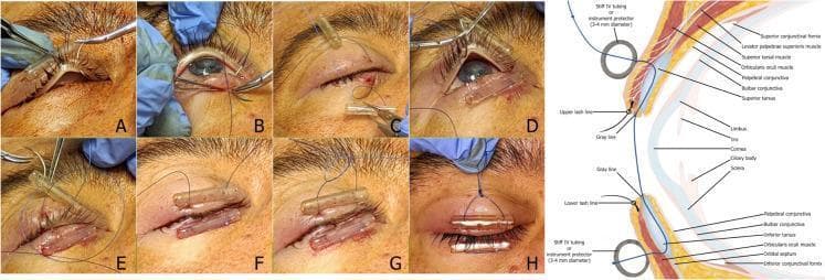 A multi-panel clinical photograph and anatomical diagram illustrating a reversible tarsorrhaphy surgical procedure. Panels A-H depict sequential intraoperative steps: a double-armed suture (4-0 Prolene) with a cutting needle is passed through soft IV tubing bolsters (used to prevent skin cheese-wiring) and the eyelid margins. The technique demonstrates the needle exiting the gray line of the upper eyelid and entering the corresponding gray line of the lower eyelid to ensure a partial-thickness bite through the tarsal plate. Panels C-F show the repetition of this path for both arms of the suture medially and laterally. Panels G-H show the placement of a sliding knot above the upper bolster, allowing for adjustable eyelid closure. An accompanying sagittal cross-section diagram labels the relevant anatomy, including the superior and inferior tarsus, orbicularis oculi muscle, gray line, and conjunctival fornices, showing the suture path through the bolsters and tarsus without penetrating the palpebral conjunctiva. This instructional material is intended for ophthalmology and oculoplastic surgery education.