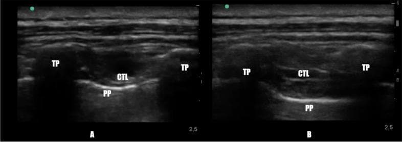 This diagnostic ultrasound comparison demonstrates the thoracic paravertebral space (TPVS) before and after the administration of a thoracic paravertebral block. Both images utilize a transverse scanning plane. Image A (pre-block) shows the baseline anatomy: the Transverse Process (TP) appears as a hypoechoic structure with acoustic shadowing; the Superior Costo-transverse Ligament (CTL) is a hyperechoic band; and the Parietal Pleura (PP) is identified as a deep, bright hyperechoic line. In Image A, the potential space between the CTL and PP is narrow. Image B (post-block) reveals the clinical significance of the procedure: the TPVS is significantly expanded by the injection of local anesthetic, visualized as a large wedge-shaped hypoechoic area. This expansion results in the downward displacement of the Parietal Pleura (PP) away from the Superior Costo-transverse Ligament (CTL). This comparison serves as an educational tool for identifying key sonoanatomy and confirming successful anesthetic spread during regional anesthesia in anesthesiology and pain management.