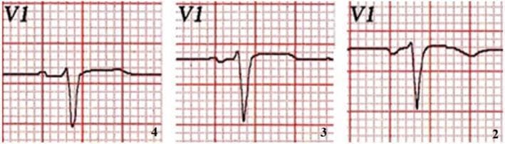 This diagnostic image displays a comparison of three Electrocardiogram (ECG) strips from the V1 lead of a healthy patient, demonstrating the impact of electrode misplacement on morphology. The traces are labeled 4, 3, and 2, corresponding to the placement of the V1 electrode in the fourth, third, and second intercostal spaces respectively. The comparison illustrates a significant progression in P wave morphology: as the electrode is moved superiorly from the standard fourth intercostal space (left) to the second (right), the P wave shifts from a biphasic appearance to an increasingly negative deflection. Additionally, changes in the QRS complex are visible, characterized by a deepening S wave and variations in R-S wave duration. This clinical visualization is used to educate medical students and clinicians on the importance of precordial lead positioning, highlighting how cranial displacement can mimic pathological states such as left atrial enlargement or Brugada-like patterns in a physiologically normal heart.