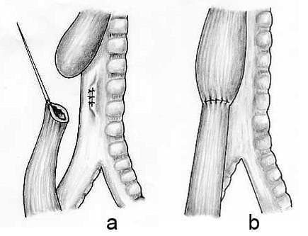 Anatomical illustration depicting the surgical repair of esophageal atresia (EA) with distal tracheoesophageal fistula (TEF). The diagram consists of two panels: (a) Pre-anastomosis state showing a dilated proximal esophageal pouch and a distal esophageal segment originating from the posterior wall of the trachea. Visible surgical interventions include the ligation and division of the fistula, evidenced by suture marks on the tracheal wall. A surgical needle and suture are shown preparing the distal esophagus for mobilization. (b) Post-operative state demonstrating a completed primary end-to-end esophageal anastomosis. The proximal and distal esophageal segments are joined with circumferential sutures, creating a continuous esophageal lumen parallel to the trachea. The trachea is shown with distinct cartilaginous rings and is now anatomically separated from the digestive tract. This illustration serves as an educational tool for pediatric surgery, highlighting the management of Type C esophageal atresia and the restoration of normal foregut anatomy.