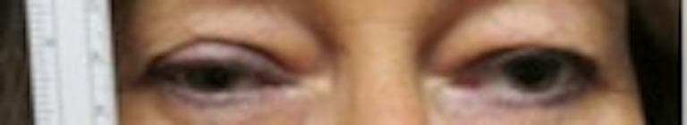 A clinical photograph focused on the periocular region of a 59-year-old female patient, demonstrating bilateral ptosis (upper eyelid drooping). The presentation is asymmetrical, with the right upper eyelid showing a more pronounced descent, covering a larger superior portion of the iris compared to the left eye. A vertical ruler is positioned on the left side of the frame as a measuring tool to quantify the palpebral fissure height or marginal reflex distance. This image represents the baseline state 'before ice test' in a clinical evaluation for neuromuscular junction disorders, such as ocular myasthenia gravis or Lambert-Eaton myasthenic syndrome (LEMS). The surrounding skin appears normal without visible inflammation or edema. This visual material is used to teach diagnostic bedside maneuvers for evaluating fatiguable ptosis and distinguishing between various causes of blepharoptosis in an ophthalmological or neurological context.
