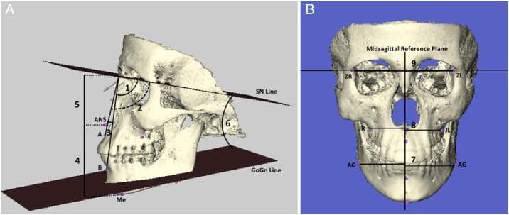Educational medical illustration featuring 3D reconstructed skull models for cephalometric analysis, divided into lateral and posteroanterior views. Panel A demonstrates lateral cephalometric measurements including: angular relationships between the anterior cranial base (SN line) and the maxilla (SNA angle, 1), mandible (SNB angle, 2), and maxillomandibular discrepancy (ANB angle, 3); mandibular plane inclination relative to the cranial base (GoGn/SN angle, 6); and linear vertical measurements for anterior upper facial height (N-ANS, 5) and lower facial height (ANS-Me, 4). Panel B shows a posteroanterior (PA) view illustrating facial symmetry analysis relative to the Midsagittal Reference Plane (MSR). It highlights linear distances from the MSR to bilateral landmarks: the frontozygomatic sutures (ZL/ZR, 9), alveolar maxillary processes (JL/JR, 8), and antegonial notches (AG, 7). These diagrams illustrate the standard radiological landmarks used in orthodontics and maxillofacial surgery to assess skeletal growth patterns and craniofacial asymmetry.