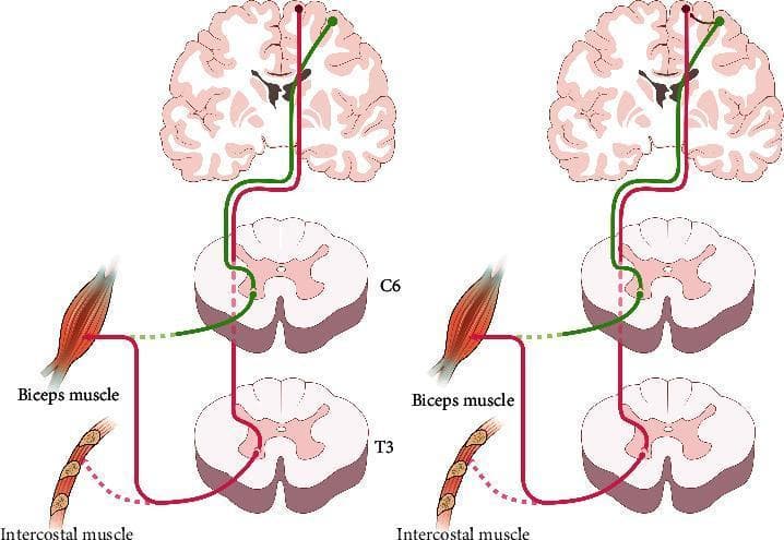 This pathophysiology diagram illustrates neuroplasticity and cortical reorganization following an intercostal-to-musculocutaneous nerve transfer for brachial plexus injury. The figure consists of two side-by-side panels showing a coronal brain section, spinal cord segments (C6 and T3), and the target muscles (biceps and intercostals).
In the early phase (left panel), motor control for the biceps originates from the medial primary motor cortex (intercostal area). The descending pathway (red) bypasses the injured C6 segment to synapse at the T3 thoracic segment, where the donor intercostal nerve provides the motor signal to the reinnervated biceps brachii. This reflects synergistic movement where biceps contraction is tied to respiration.
In the late phase (right panel), the 'cortical shifting phenomenon' is shown. A new functional connection (curved arrow) has formed between the lateral arm representation area and the medial intercostal area. While the physical nerve route via T3 remains (red line), the green pathway signifies that the lateral motor cortex now exerts control over elbow flexion. This illustrates the central nervous system's ability to adapt, allowing the patient to perform independent voluntary biceps contraction separate from respiratory activity.