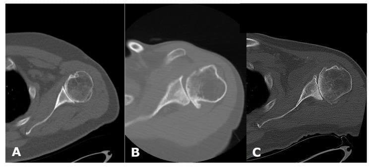 This image presents three axial computed tomography (CT) scans of the human shoulder, demonstrating the Walch classification system for glenoid morphology in primary glenohumeral osteoarthritis. Each panel illustrates a different stage of glenoid wear and humeral head alignment. Panel A shows a Walch A morphology, characterized by a centered humeral head and symmetric glenoid wear. Panel B demonstrates a Walch B1 morphology, where there is mild posterior joint space narrowing and subluxation of the humeral head without significant biconcavity. Panel C displays a Walch B2 morphology, highlighting significant posterior glenoid erosion and the development of a 'biconcave' glenoid surface, often resulting in severe posterior humeral head subluxation. Key anatomical landmarks visible include the humeral head, glenoid fossa, coracoid process, and scapular spine. These images serve as a diagnostic guide for preoperative planning in total shoulder arthroplasty, specifically for assessing glenoid version and bone stock loss.