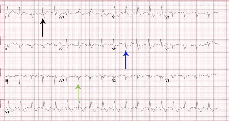 A standard 12-lead electrocardiogram (ECG) displayed on a pink grid background, illustrating bifascicular block findings. The tracing reveals sinus tachycardia with a marked left axis deviation, characterized by a predominantly positive QRS complex in lead I (black arrow) and a negative QRS deflection in lead aVF (green arrow). The precordial leads show classic morphology for a right bundle branch block (RBBB), specifically highlighting an rsR' pattern in lead V2 (blue arrow). Combined, the left axis deviation (suggestive of left anterior fascicular block) and the RBBB findings constitute a bifascicular block. The image provides clinical teaching value for identifying intraventricular conduction delays and cardiac axis abnormalities in an acute clinical setting.