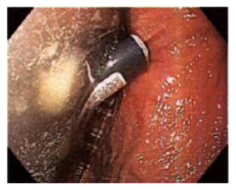 This clinical photograph shows an upper gastrointestinal endoscopy (EGD) of the gastric mucosa. The image displays a non-bleeding, cratered gastric ulcer located at the incisura angularis. The ulcer is characterized by a central depression with a pale base, surrounded by significantly inflamed gastric tissue. The surrounding mucosa demonstrates diffuse moderate gastritis, marked by erythema (redness), vascular congestion, and a friable texture. An endoscopic instrument, likely a polypectomy snare or retrieval device, is visible in the foreground, indicating an active interventional procedure. This image illustrates gastric mucosal injury and ulceration, which in this clinical context is secondary to chemical irritation from a foreign body (cigarette lighter fluid). It serves as an educational example of corrosive-induced peptic ulcer disease and the endoscopic appearance of acute gastric inflammation.