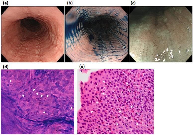This composite educational image illustrates diagnostic modalities for Eosinophilic Esophagitis (EoE) in a 52-year-old patient. Panels (a) and (b) present White Light Endoscopy (WLE) and indigocarmine chromoendoscopy, respectively, showing classic endoscopic features: linear furrows, white exudates, and concentric rings (trachealization) within the esophageal lumen. Panel (c) utilizes Narrow-Band Imaging Magnifying Endoscopy (NBI-ME), demonstrating beige-colored mucosa and characteristic dot-shaped intrapapillary capillary loops (IPCLs) without visible cyan vessels. Panel (d) displays high-magnification endocytoscopy (x520), an in vivo imaging technique showing multiple cells with purple bilobed nuclei and nonstained peripheries (white arrowheads), characteristic of eosinophilic infiltration. Panel (e) provides histological correlation (H&E stain) from a biopsy of the same site, confirming dense eosinophilic infiltration (>50 eosinophils per high-power field) with prominent bilobed nuclei (white arrowheads). The image provides a comprehensive comparison between gross endoscopic findings, advanced in vivo microscopy, and gold-standard histopathology for gastroenterology education.