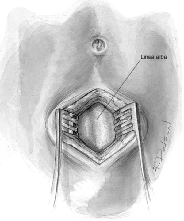 This medical illustration depicts a surgical view of the anterior abdominal wall during a midline infraumbilical incision, typically performed for Diagnostic Peritoneal Lavage (DPL). The umbilicus serves as the primary anatomical landmark at the superior aspect of the field. The skin and subcutaneous fat layers have been incised and are being laterally displaced by two self-retaining or handheld retractors to expose the underlying deep fascia. Centered within the retracted operative field is the linea alba, shown as a distinct, vertical, fibrous band of connective tissue where the aponeuroses of the abdominal muscles meet. The illustration highlights the relationship between the superficial integumentary layers and the dense abdominal fascia, emphasizing the surgical approach required to reach the preperitoneal space. This diagram is designed for educational use in teaching surgical access, emergency trauma procedures, and abdominal anatomy.