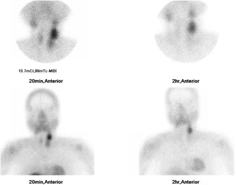 This diagnostic image displays a dual-phase 99mTc-sestamibi (MIBI) parathyroid scintigraphy scan, consisting of anterior views of the neck and upper mediastinum. The study includes early images (20 minutes post-injection) and delayed images (2 hours post-injection). In the early phase, there is generalized radiotracer uptake within the thyroid gland and a focal, intense area of hyperconcentration located at the left superior pole of the thyroid. In the delayed phase, the thyroid gland demonstrates significant radiotracer washout. However, the focal lesion at the left superior pole shows persistent retention of the radiotracer, a classic finding indicative of a parathyroid adenoma. The mediastinal region shows no evidence of ectopic parathyroid tissue. This modality is primarily used in the evaluation of primary hyperparathyroidism to localize hyperfunctioning parathyroid glands prior to surgical intervention. The comparison between early uptake and delayed retention allows for differentiation between normal thyroid tissue and hyperactive parathyroid tissue.
