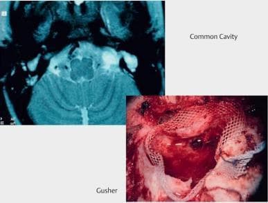 This composite educational graphic features two distinct medical images related to cochlear implant (CI) surgery in cases of inner ear malformations. The upper left diagnostic image is a high-resolution axial computerized tomography (CT) scan of the temporal bones with a teal-colored filter. It demonstrates a 'Common Cavity' malformation, characterized by a single confluent ovoid cystic space representing the vestibulocochlear organ, lacking a distinct cochlea and vestibule. The lower right image is an intraoperative clinical photograph showing a surgical site during mastoidectomy. The field is heavily obscured by an active 'gusher,' a significant outflow of cerebrospinal fluid (CSF) or perilymph from the cochleostomy, often associated with wide internal auditory canal connections in malformed ears. Visible in the surgical field are blood, exposed soft tissues, and white mesh-like packing or surgical sponges used to manage the fluid egress. These images highlight the diagnostic and intraoperative challenges faced during cochlear implantation in patients with complex inner ear anatomy.