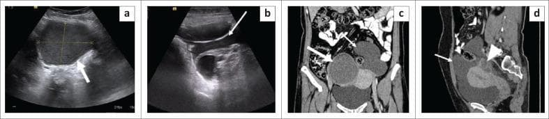This diagnostic imaging composite displays grey-scale ultrasound and Contrast-Enhanced Computed Tomography (CECT) images of the pelvis in a 38-year-old female, demonstrating features of benign cystic mesothelioma. Panels (a) and (b) are transverse ultrasounds showing two distinct lesions: a well-defined cystic mass with low-level internal echoes ('ground glass' appearance) in the right adnexa, and an ill-defined, thin-walled multiloculated cystic lesion in the midline and left pelvis. Panels (c) and (d) provide coronal and sagittal CECT views, respectively. The right adnexal cyst is hyperdense (~33 HU), while the larger, multilobulated pelvic lesion shows fluid attenuation (~18 HU) with thin, imperceptible walls. The sagittal view (d) highlights the multiloculated lesion's relationship to pelvic anatomy, situated anterior and superior to the uterus and encasing the left ovary posteriorly. Key educational findings include the absence of internal calcifications or mural nodules, which helps differentiate this benign entity from malignant mesothelioma or peritoneal carcinomatosis. The presentation is also characteristic of peritoneal inclusion cysts often associated with endometriosis.
