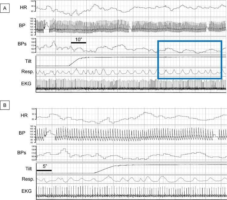 This diagnostic composite shows physiological recordings from a healthy volunteer during head-up tilt testing, presented in two panels (A and B) with different time scales. Each panel displays synchronized waveforms for Heart Rate (HR), Blood Pressure (BP), Systolic Blood Pressure (BPs), Tilt angle, Respiration (Resp.), and Electrocardiogram (EKG). The primary educational focus is the identification of Mayer waves—low-frequency oscillations in blood pressure—and their relationship to respiration and orthostatic stress. Panel A features a blue rectangle highlighting that the BPs oscillations (Mayer waves) occur at a significantly lower frequency than the respiratory cycles, indicating they are not respiratory-driven. Following the upward tilt, the BPs maintains stability without the precipitous drop characteristic of orthostatic hypotension. The EKG and HR tracings provide context for cardiac autonomic response during the postural change. This visualization is used in cardiology and neurology to distinguish between normal autonomic blood pressure regulation and neurogenic orthostatic hypotension.