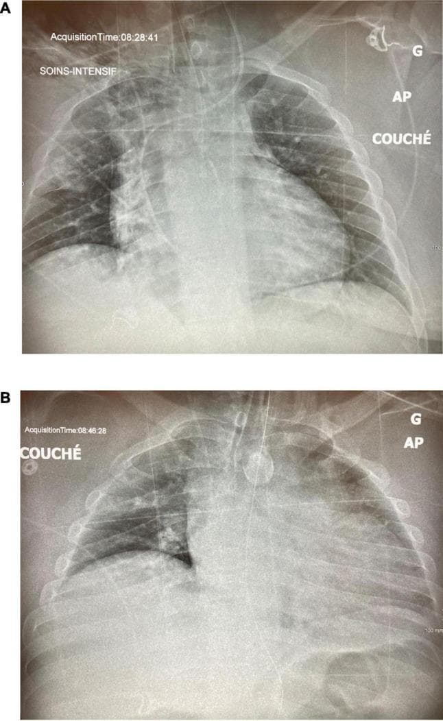 This comparison chart displays two anteroposterior (AP) chest X-rays in the supine (COUCHÉ) position, highlighting the progression of pulmonary pathology in a critical care setting. Image A, taken on ICU Day 5, demonstrates extensive bilateral pulmonary opacities, particularly prominent in the left lung field where they partially obscure the cardiac silhouette and hemidiaphragm, consistent with severe pneumonia or ARDS. Image B, from ICU Day 13, shows a interval decrease in lung volumes and a subsequent increase in bilateral opacification, particularly in the lower zones, suggesting derecruitment or disease progression. Both images show medical support devices including an endotracheal tube with an inflated cuff visible in the mid-trachea and various external monitoring leads. Educational focus is on the radiological assessment of alveolar recruitment and the visual changes associated with mechanical ventilation strategies in patients with severe respiratory failure. The images serve as a comparison of lung aeration over time during intensive care management.