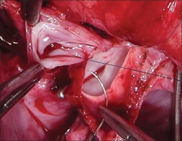 This intraoperative clinical photograph captures a Bidirectional Glenn (BDG) shunt procedure, specifically demonstrating an end-to-side anastomosis between the superior vena cava (SVC) and the right pulmonary artery (PA). The surgical field shows the dissected vessels held in a bloodless state. Multiple surgical instruments are visible, including vascular forceps and clamps used to manipulate and stabilize the vessel walls. A curved surgical needle and fine 6-0 polypropylene stay sutures are actively positioned at the anastomosis site to secure the junction. The interior lumen of the vascular structures is visible, showing the smooth endothelial surface and the thickness of the vessel walls. This image illustrates a critical step in pediatric cardiac surgery for congenital heart defects, emphasizing the precise suturing technique required to establish reliable pulmonary blood flow from the systemic venous circulation.