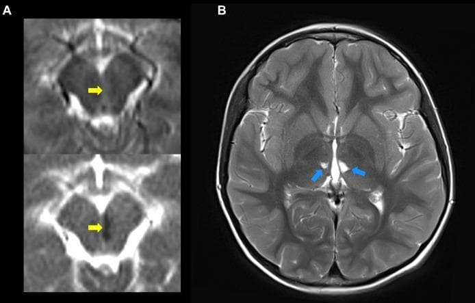 Diagnostic axial MRI brain scans demonstrating acute and chronic ischemic manifestations in a pediatric patient with Deficiency of Adenosine Deaminase 2 (DADA2). Panel A (left) displays an acute infarct in the left paramedial midbrain. The top image is a Diffusion-Weighted Imaging (DWI) sequence showing a focal area of hyperintensity (yellow arrow), and the bottom image is a corresponding Apparent Diffusion Coefficient (ADC) map showing signal hypointensity (yellow arrow), confirming true diffusion restriction characteristic of an acute stroke. Panel B (right) is a T2-weighted axial image at the level of the basal ganglia and thalamus. Blue arrows point to bilateral, small, hyperintense focal lesions in the thalamus, representing chronic lacunar infarcts. The clinical context highlights the tendency of this inflammatory vasculopathy to cause recurrent strokes in deep brain structures, including the midbrain, thalamus, and pons, often at a very young age.