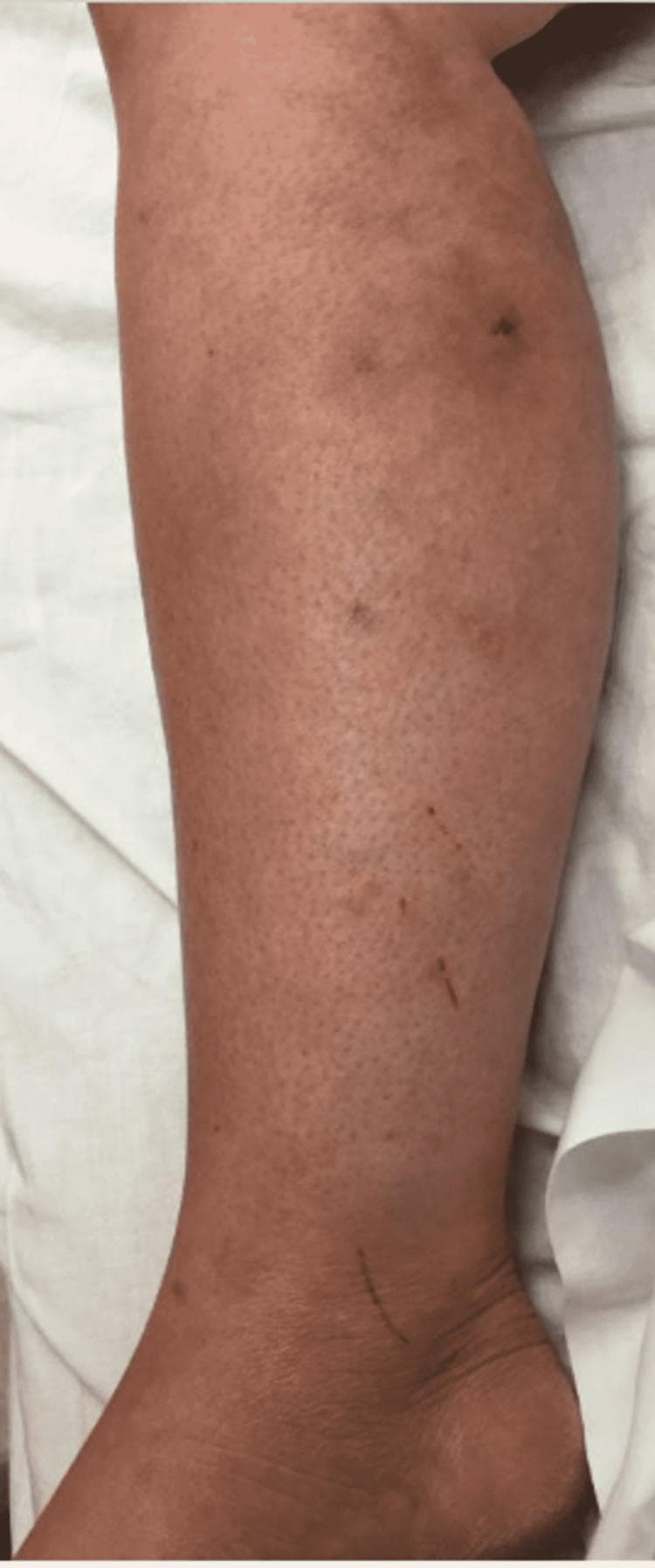 This clinical photograph displays the right lower extremity (RLE) of a patient, showing the lateral and posterior aspects of the lower leg and ankle. The skin exhibits diffuse, patchy erythema with a somewhat mottled appearance, characteristic of resolving cellulitis. Several small, discrete, hyperpigmented macules or crusting lesions are scattered across the mid-calf region. Linear abrasions or excoriations are visible near the lateral malleolus and lower shin. The image illustrates the clinical progression of an atypical mycobacterial infection (specifically Mycobacterium chelonae) undergoing treatment. The lack of severe edema or fluctuance suggests improvement from an acute infectious state. This visual is relevant for dermatology and infectious disease specialties, particularly in identifying the cutaneous manifestations of non-tuberculous mycobacteria (NTM) which can mimic standard bacterial cellulitis.