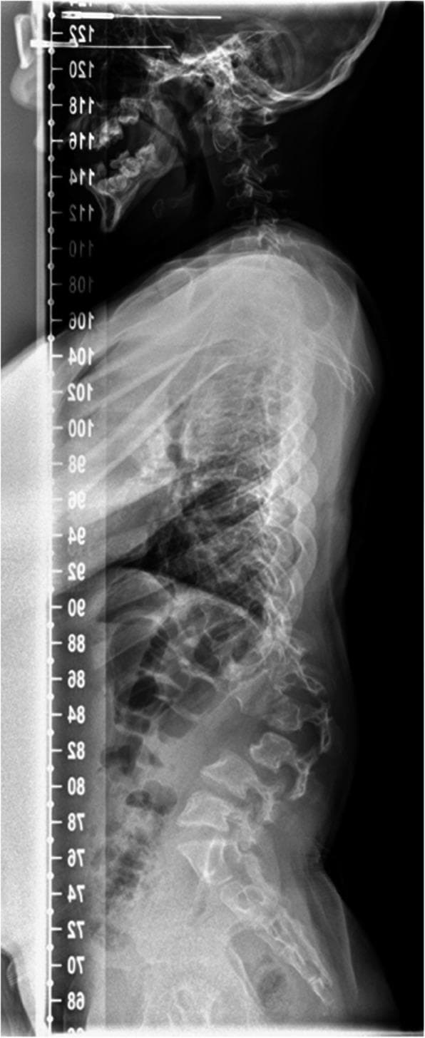This lateral view X-ray radiography shows a pre-operative sagittal profile of the cervical, thoracic, and lumbar spine. The image reveals a significant thoracolumbar kyphosis, particularly pronounced at the high lumbar region. The normal lumbar lordosis is absent, replaced by a forward angulation of the spine. The vertebral bodies in the affected lumbar and thoracic segments demonstrate dysplastic changes characteristic of dysostosis multiplex, including anterior beaking and wedging, where the anterior height is significantly reduced compared to the posterior height. This structural abnormality leads to narrowed and irregular intervertebral spacing and global spinal malalignment. The bone density appears heterogenous with areas of radiolucency. This radiograph is a classic clinical example of spinal manifestations associated with Mucopolysaccharidosis Type 1 (MPS 1), illustrating the severe skeletal deformities that require orthopedic intervention to prevent neurological compromise and improve functional gait outcomes.