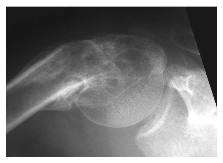 This diagnostic image is a fluoroscopic radiograph of a human shoulder joint, demonstrating a significant varus deformity of the proximal humerus. The humerus is positioned in abduction, showcasing the dynamic relationship between the glenohumeral structures. Key anatomical features include a malaligned humeral head and an prominent greater tuberosity resulting from a malunited surgical neck fracture. The image captures the mechanical block to abduction where the greater tuberosity makes contact with the superior margin of the glenoid rim, rather than the acromion. This pathological contact illustrates the clinical significance of a reduced neck-shaft angle in post-traumatic deformities. Visible bony landmarks include the humeral shaft, humeral head, glenoid fossa, and the lateral aspect of the scapula. The radiograph is intended for orthopedic education regarding the assessment of shoulder impingement mechanisms and the biomechanical consequences of proximal humeral malunion.