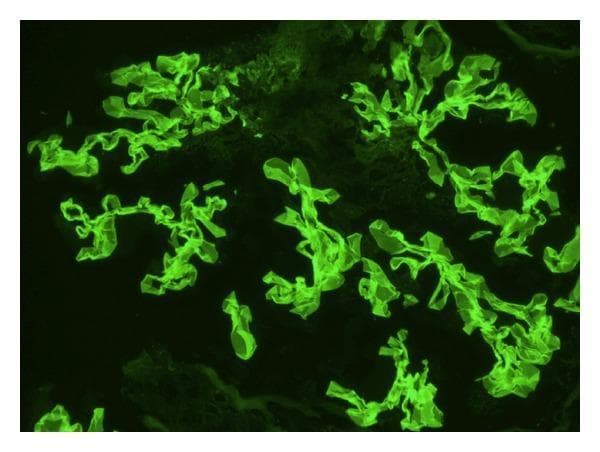 This diagnostic image is a direct immunofluorescence (DIF) micrograph of human renal tissue. The image demonstrates a characteristic linear staining pattern along the glomerular basement membrane (GBM). The fluorescent signal, appearing as a bright green (FITC) stain, reveals continuous, ribbon-like deposits of IgG that follow the complex, convoluted contours of the glomerular capillaries. This specific linear distribution is a hallmark of anti-GBM disease, such as Goodpasture syndrome, distinguishing it from the granular deposits typically seen in immune-complex-mediated glomerulonephritis. The clusters of highlighted structures represent multiple glomerular segments within the biopsy sample, showing uniform intensity of antibody binding. This finding is critical for the diagnosis of rapidly progressive glomerulonephritis (RPGN) and guides urgent clinical intervention like plasmapheresis and high-dose corticosteroid therapy.