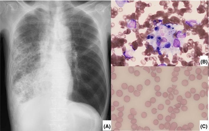 This composite medical image consists of three panels demonstrating clinical findings in a case of severe infection and systemic complications. (A) Anterior-posterior chest X-ray showing extensive, ill-defined heterogeneous opacification and consolidation in the middle and lower zones of the right lung field, consistent with severe pneumonia. (B) High-magnification bone marrow aspirate (Wright-Giemsa stain) revealing active hemophagocytosis, characterized by a large macrophage engulfing multiple hematopoietic cells, including erythrocytes and precursors, indicative of hemophagocytic lymphohistiocytosis (HLH). (C) Peripheral blood smear (Wright-Giemsa stain) showing numerous schistocytes (fragmented red blood cells) including helmet cells and triangular forms, alongside a loss of central pallor in some cells. These findings are diagnostic of microangiopathic hemolytic anemia (MAHA) secondary to thrombotic microangiopathy (TMA). Together, these panels illustrate the progression from a primary pulmonary infection to secondary multisystem hematologic pathologies including septic shock-induced HLH and ADAMTS-13 associated TMA.