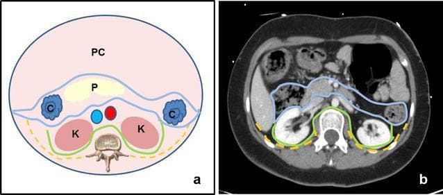 This dual-panel educational material illustrates the anatomy of the retroperitoneal space using a comparative approach. Panel (a) is a schematic anatomical diagram in axial cross-section. It delineates the three main retroperitoneal compartments: the anterior pararenal space (outlined in blue), containing the pancreas (P) and ascending/descending colon (C); the perirenal space (outlined in green), housing the kidneys (K), adrenal glands, and perirenal fat; and the posterior pararenal space (outlined in yellow dashed lines), located between the posterior renal fascia and the transversalis fascia. The peritoneal cavity (PC) is shown anteriorly. Panel (b) presents a corresponding axial CT scan with intravenous contrast, applying the same color-coded boundary lines to clinical imaging. The CT demonstrates the contrast-enhanced kidneys within the perirenal space and the relative positions of the pancreas and bowel. This comparison aids in understanding fascial planes and the compartmentalization of potential retroperitoneal pathology, such as hematomas or abscesses, which are often confined by these anatomical boundaries.