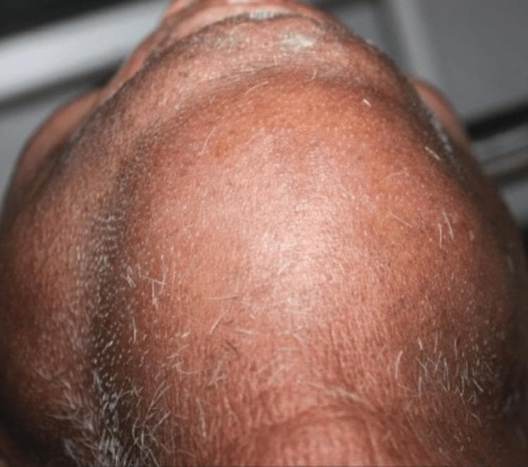 This clinical photograph displays an inferior-to-superior view of a patient's neck and submental region, demonstrating significant, diffuse soft tissue swelling characteristic of Ludwig's angina. The swelling involves the bilateral submandibular and sublingual spaces, resulting in a firm, 'woody' induration that obscures normal anatomical contours. The skin surface appears taut, stretched, and erythematous, indicating underlying acute inflammation. Visible skin wrinkling and grey facial hair suggest an older adult patient. The clinical presentation is highly suggestive of a rapidly spreading cellulitis of the submandibular space, often secondary to odontogenic infections, which poses a severe risk of airway obstruction. This image serves as an educational tool for identifying the external manifestations of floor-of-mouth infections and the necessity for urgent surgical decompression and airway management.
