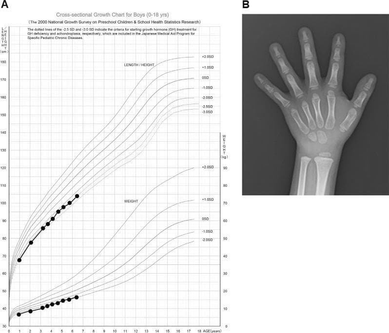This composite educational figure illustrates the clinical assessment of pediatric growth and skeletal maturation. Panel A displays a cross-sectional growth chart for boys (ages 0-18 years) depicting length/height and weight trajectories. The patient’s data points, plotted against standard deviation (SD) curves, show persistent short stature with height tracking below the -2.0 SD line, reaching approximately -2.4 SD at age 7. Panel B is a posterior-anterior (PA) diagnostic radiograph of the left hand and wrist used for bone age assessment. Visible anatomical structures include the distal radius and ulna, carpal bones, metacarpals, and phalanges. Key educational features include the presence of open epiphyseal plates (growth plates) and specific ossification centers. In this clinical context, the radiograph demonstrates delayed bone maturation, where the skeletal development corresponds to a bone age significantly younger (3-year delay) than the patient’s chronological age of 7 years. This combination of growth velocity tracking and bone age radiography is a primary diagnostic approach in evaluating pediatric endocrine and genetic conditions such as NBAS mutation-based diseases.
