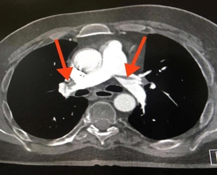This diagnostic image is an axial cut from a CT Pulmonary Angiography (CTPA) demonstrating extensive pulmonary embolism. The primary visual finding is a large, low-attenuation filling defect appearing as a 'saddle embolus' at the bifurcation of the main pulmonary artery, extending into both the right and left main pulmonary arteries (indicated by red arrows). The central filling defects are characterized by absent or significantly reduced contrast enhancement within the vessel lumens, which are otherwise surrounded by hyperdense contrast material. Additional thromboembolic material is visible in the lobar and segmental branches bilaterally. The main pulmonary artery shows evidence of distension secondary to the large obstructive clot burden. This image serves as a classic clinical example of acute, high-burden pulmonary embolism in a patient with risk factors such as prolonged immobility, illustrating the critical role of CTPA in diagnosing life-threatening vascular obstructions.