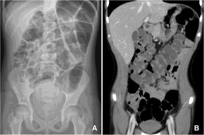 This composite diagnostic image illustrates acute colonic pseudo-obstruction, also known as Ogilvie's syndrome. Image A is an anteroposterior (AP) abdominal X-ray demonstrating marked, gaseous dilatation of the colon extending from the cecum through the splenic flexure. Notably, there is an absence of air-fluid levels or signs of pneumoperitoneum (free air). Image B is a coronal computed tomography (CT) scan of the same patient, providing a more detailed view of the massive large bowel dilatation. The CT reveals a clear transition and confirms that while the large bowel is severely distended, there is minimal involvement of the small bowel loops. Both imaging modalities highlight the lack of a mechanical obstructive lesion, pointing toward a functional motility disorder. These findings are clinically significant for diagnosing colonic pseudo-obstruction in a hospital setting, typically managed with bowel rest and pharmacological interventions.