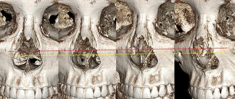 This diagnostic image consists of a series of four 3D computed tomography (CT) reconstructions of a human skull, focusing on the midface and nasal region. The panels illustrate the spatial relationship between rhinoplasty surgical landmarks and internal nasal anatomy. A red dotted line represents the lateral osteotomy path along the frontal process of the maxilla and nasal bones. A yellow dotted line indicates the anatomical attachment level of the inferior turbinates to the lateral nasal wall. In all views, the lateral osteotomy line (red) is positioned superior to the inferior turbinate attachment line (yellow). The images highlight the 'safe zone' for osteotomies relative to the pyriform aperture and the nasal cavity's internal structures. This comparison is clinically significant for surgical planning to avoid inferior turbinate medialization or airway compromise during nasal bone narrowing. Key structures visible include the orbits, nasal aperture, maxilla with dental arch, and the internal bony framework of the nasal passage.