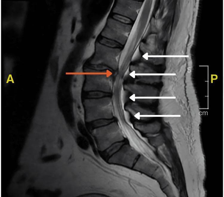 This sagittal T2-weighted MRI scan of the lumbosacral spine demonstrates multilevel thecal sac compression. Key diagnostic features include spinal epidural lipomatosis, characterized by an abnormal accumulation of hyperintense fat in the dorsal epidural space (indicated by white arrows), which narrows the spinal canal and displaces the thecal sac anteriorly. Additionally, a focal L2-L3 intervertebral disc herniation is visible (indicated by the orange arrow), further contributing to canal stenosis by protruding posteriorly. The vertebral bodies show mild degenerative changes, and the overall image illustrates the combined mechanical impact of epidural fat deposition and disc pathology on the neural structures within the lumbar spinal canal. This imaging is characteristic of conditions causing radiculopathy or neurogenic claudication, and serves as an educational example of extrinsic compression of the thecal sac.