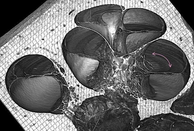 This diagnostic image is a virtual mid-modiolar cross-section of a human cochlea obtained via synchrotron radiation phase contrast imaging (SR-PCI). The image displays the characteristic spiraling architecture of the cochlea, showcasing multiple turns of the bony labyrinth. Within these turns, the three primary fluid-filled chambers—scala vestibuli, scala media (cochlear duct), and scala tympani—are clearly visible as distinct, rounded compartments separated by thin membranes. The osseous spiral lamina is evident as a bony projection extending into the lumen. A magenta arrow specifically identifies the location and orientation of the organ of Corti sitting upon the basilar membrane. The grayscale intensities reflect varying tissue densities, with the surrounding bone and connective tissue exhibiting a porous, mesh-like texture. This advanced imaging modality provides high-contrast visualization of the internal sensory epithelium and membranous partitions, facilitating the study of inner ear anatomy and pathologies related to sensorineural hearing loss (SNHL).