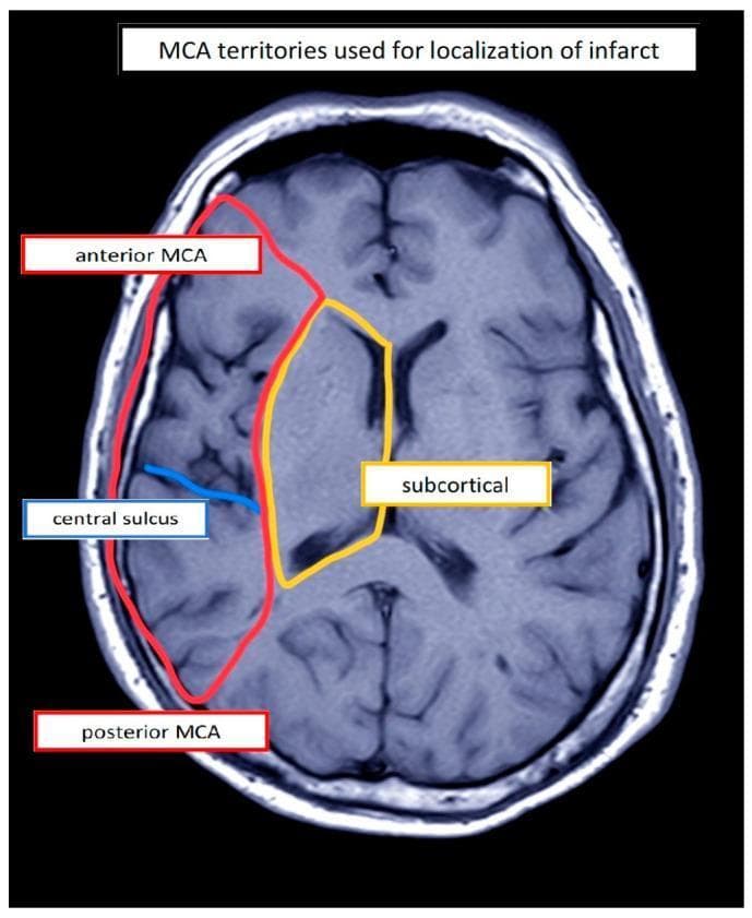 This diagnostic image is a transverse axial section of a brain MRI, utilized to demonstrate Middle Cerebral Artery (MCA) territories for infarct localization. The image displays the cerebral hemispheres with clearly defined cortical gyri and sulci. Colored overlays delineate specific neuroanatomical regions in the left hemisphere: two red-outlined areas identify the anterior MCA territory (frontal region) and the posterior MCA territory (parietal/temporal region). These cortical territories are separated by a blue line marking the central sulcus. A yellow-outlined region indicates the deeper subcortical territory, encompassing the basal ganglia and internal capsule regions. The image serves as an educational tool for stroke neurology and neuroradiology, illustrating the vascular distribution of the MCA and the anatomical landmarks used to categorize ischemic lesions. Such classification is clinically relevant for assessing stroke severity and predicting functional outcomes, such as aphasia or motor deficits.