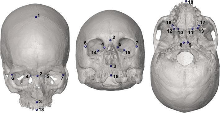 Anatomical diagram of a human skull providing a 3D landmark configuration for craniometric analysis. The image displays 18 numbered landmarks from three primary perspectives: frontal (anterior), tilted anterior, and basal (inferior) views. These landmarks represent key anatomical points of interest (COIs) used in medical imaging and forensic anthropology to define surgical planes and calculate volumes of cranial cavities such as the nasal cavity, maxillary sinuses, and orbits. Frontal landmarks include the glabella (1), nasion (2), and markers along the superior orbital margins (4, 5) and zygomatic arches (6, 7). The basal view illustrates the distribution of landmarks across the palate (10, 11, 16, 17), the midline of the alveolar process (18), and the cranial base near the foramen magnum (8, 9). This structured mapping is designed for digital morphometrics, providing a standardized protocol for identifying cranial structures and performing volumetric assessments in clinical and research settings.