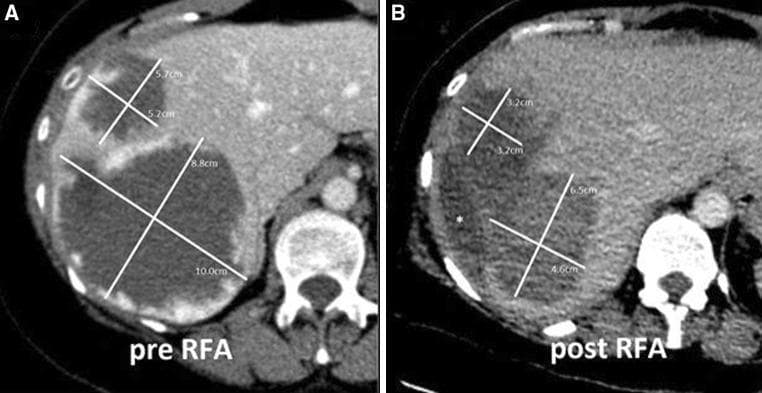 This diagnostic comparison chart consists of two side-by-side axial contrast-enhanced CT scans of the upper abdomen, labeled 'pre RFA' (A) and 'post RFA' (B), demonstrating the treatment of hepatic giant cavernous hemangiomas (GCHs). Image A shows two large, 'mating' hypodense masses in liver segments VII and VIII. The larger, inferior mass measures 10.0 x 8.8 cm, and the superior mass measures 5.7 x 5.2 cm. Both lesions exhibit characteristic peripheral nodular enhancement and heterogeneous internal consistency. Image B, taken after bipolar radiofrequency ablation (RFA), shows a significant reduction in tumor volume. The larger lesion has decreased to 6.5 x 4.6 cm, and the smaller to 3.7 x 3.2 cm. Post-treatment changes include increased internal density, slightly more irregular margins, and an asterisk marking a fluid-filled space formed by tumor retraction. The scans illustrate the efficacy of bipolar RFA in achieving tumor shrinkage and debulking for symptomatic benign liver lesions when surgical resection is high-risk.