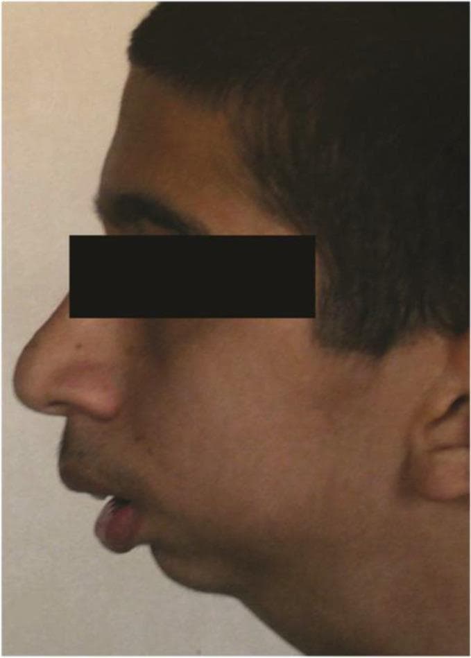 A clinical photograph displaying a left lateral facial profile of a 16-year-old male patient with bilateral temporomandibular joint (TMJ) ankylosis. The image illustrates significant mandibular retrognathia, characterized by a posterior displacement of the mandible relative to the maxilla, resulting in a convex facial profile and a deficient lower facial third. Key visible features include a retrusive chin, a normal nasolabial angle, and slightly convex nasal morphology. The lips are slightly incompetent and parted, with the tip of the tongue visible between the dental arches, suggesting potential airway compromise or secondary tongue thrusting. This preoperative view demonstrates the aesthetic and structural impact of long-standing TMJ ankylosis on maxillofacial development, often colloquially referred to as 'bird-face' deformity. The image is a primary educational resource for oral and maxillofacial surgery, illustrating the indications for mandibular distraction osteogenesis.