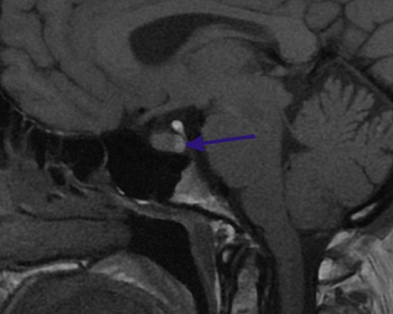 This diagnostic image is a T1-weighted sagittal Magnetic Resonance Imaging (MRI) scan of the human brain, specifically centered on the sella turcica and the midbrain structures. A blue arrow points to a distinct, focal hyperintense signal within the posterior aspect of the pituitary gland, known as the 'posterior pituitary bright spot.' This finding represents a normal radiological landmark indicating the storage of neurohypophyseal hormones (vasopressin and oxytocin) within the neurohypophysis. Anatomical landmarks clearly visible include the anterior pituitary (adenohypophysis), the pituitary stalk (infundibulum), the optic chiasm located superiorly, the sphenoid sinus inferiorly, and the pons and cerebellum posteriorly. The image serves as a clinical reference for normal pituitary anatomy in neuroimaging, distinguishing physiological hyperintensity from pathological lesions such as microadenomas or cysts.