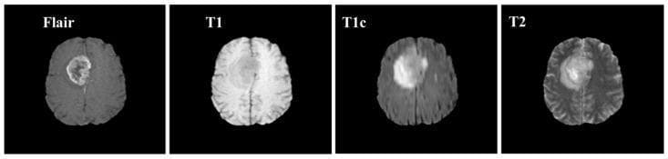 This diagnostic image set showcases axial brain Magnetic Resonance Imaging (MRI) across four distinct modalities: Fluid-Attenuated Inversion Recovery (FLAIR), T1-weighted (T1), T1-weighted contrast-enhanced (T1c), and T2-weighted (T2) sequences. The comparison illustrates a large neoplastic lesion, likely a glioma, in the right hemisphere. In the T1 sequence, the lesion appears hypointense relative to healthy white matter. The T1c (gadolinium-enhanced) image demonstrates significant contrast enhancement, indicating a breakdown of the blood-brain barrier within the tumor core. The T2-weighted image shows the lesion and surrounding vasogenic edema as hyperintense (bright) signals, reflecting high fluid content. The FLAIR sequence effectively suppresses the signal from cerebrospinal fluid (CSF) while maintaining hyperintensity in the peritumoral edema, allowing for clearer differentiation between the pathological mass and surrounding fluid-filled spaces. This multi-parametric approach is fundamental in neuroradiology for assessing tumor margins, vascularity, and associated tissue changes for clinical diagnosis and surgical planning.