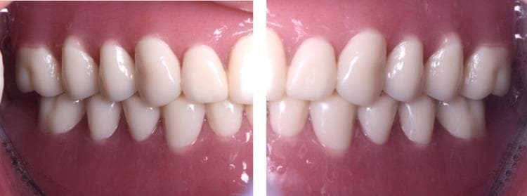 This composite intra-oral photograph shows two lateral views of newly placed CAD/CAM (Computer-Aided Design/Computer-Aided Manufacturing) complete dentures in a patient with edentulism. The image illustrates the maxillary and mandibular prostheses in centric occlusion. The artificial teeth exhibit a light shade, anatomical ovoid morphology, and natural-looking interdigitation with a stable occlusal relationship. The denture bases are fabricated from pink-pigmented acrylic resin designed to mimic natural gingival tissue and show smooth contours with appropriate adaptation to the vestibular mucosa. Key educational features include the demonstration of dental esthetics, tooth arrangement, and the integration of digital prosthetic technology in managing cases with significant alveolar ridge resorption. The clinical focus is on the final functional and esthetic outcome of digital denture fabrication.