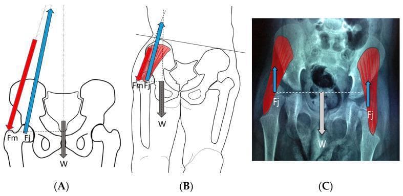 This medical illustration and diagnostic composite compares biomechanical forces acting on the pediatric hip joint across three clinical scenarios. Panel (A) depicts a normal child during the stance phase of gait; a free-body diagram shows the balance between the body weight moment (W, downward vector), the abductor muscle force (Fm, downward-lateral vector), and the resulting hip joint reaction force (Fj), which is directed medially into the acetabulum at an oblique angle. Panel (B) illustrates a weak or hypotonic ambulatory child with a trunk lurch; here, the abductor force (Fm) is significantly reduced, resulting in a more vertically oriented and smaller joint reaction force (Fj). Panel (C) presents an anteroposterior pelvic radiograph of a child in static standing, with superimposed vector analysis; in this state, the joint reaction force (Fj) is minimal and purely vertical, counteracting approximately half of the body weight (W). The diagrams illustrate how gait and muscle tone influence the magnitude and direction of hip impulse, which are critical factors in the development of the femoral neck-shaft angle and acetabular depth.