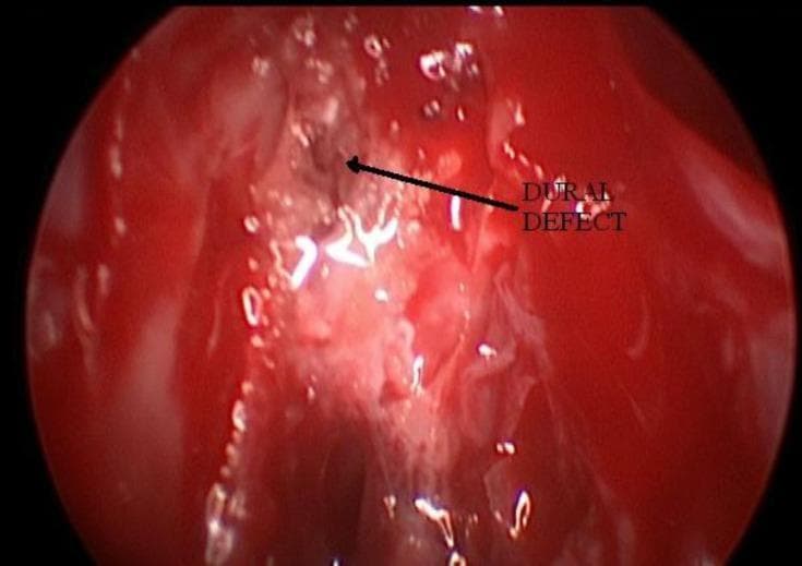 An intraoperative diagnostic nasal endoscopy image showing the skull base during a cerebrospinal fluid (CSF) rhinorrhea repair procedure. The view depicts highly vascular, erythematous (bright red) nasal mucosa and ethmoidal tissue. An arrow points to a centrally located 'Dural Defect', which appears as a small, irregular, dark brownish-black focal point within the surrounding inflamed tissue. White, translucent areas of possible CSF drainage or mucosal reflections are visible around the site of the leak. The image illustrates the localization of a dural breach, essential for subsequent endoscopic repair using fat or fascia lata grafts. This clinical photograph is used to demonstrate surgical anatomy and the visual presentation of skull base defects in neuro-otolaryngology.