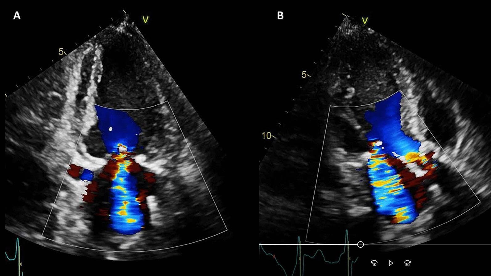 Two color Doppler transthoracic echocardiography images (TTE) demonstrating valvular pathology in a patient with heart failure. Figure A displays an apical two-chamber view, while Figure B shows an apical three-chamber view. In both panels, a prominent blue-colored systolic jet originates from the mitral valve and extends deep into the left atrium, signifying severe mitral regurgitation (MR) with flow moving away from the ultrasound transducer. Concurrently, the aortic valve region exhibits high-velocity, turbulent flow, visualized as a multi-colored mosaic pattern (red, yellow, and blue) within the left ventricular outflow tract and proximal aorta. These findings are clinically indicative of hemodynamically significant mitral regurgitation and concurrent aortic valve dysfunction, such as stenosis or regurgitation. The images include anatomical landmarks of the left ventricle and left atrium, with ECG gating visible at the bottom of the frames, providing essential visual evidence for assessing valvular heart disease and its impact on cardiac hemodynamics.