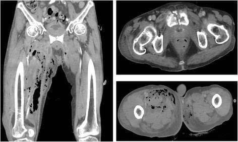 Diagnostic Image: This composite shows a computerized tomography (CT) scan in coronal (left) and axial (right top and bottom) views, focusing on the pelvis and lower extremities. The images demonstrate extensive subcutaneous and deep soft tissue gas (emphysema), characterized by multiple low-attenuation (black) bubbles and streaks. These gas pockets are primarily localized to the right femoral region, tracking along fascial planes, and extending into the retroperitoneal space. A significant skeletal abnormality is visible in the upper axial slice, showing a fracture and cortical disruption of the pubic bone/symphysis. The soft tissues exhibit marked swelling, distortion, and loss of normal muscle planes, with surrounding increased density suggestive of edema and inflammation. These findings are highly characteristic of a severe, necrotizing soft tissue infection (necrotizing fasciitis) potentially secondary to osteomyelitis or urinary fistulation. Key educational concepts include the identification of gas-forming infections, recognition of fascial plane disruption, and the evaluation of pelvic fractures in the context of surrounding soft tissue pathology.