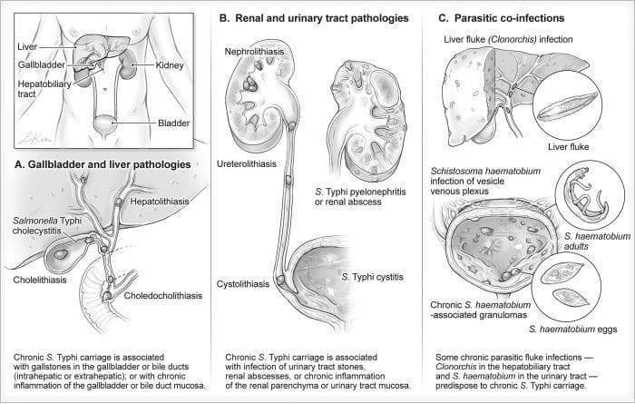 This medical illustration depicts anatomical locations and pathological conditions associated with chronic Salmonella Typhi carriage. The graphic is divided into three sections: (A) Gallbladder and liver pathologies, showing Hepatolithiasis, S. Typhi cholecystitis, Cholelithiasis, and Choledocholithiasis, illustrating how stones in the biliary system provide a niche for bacterial persistence. (B) Renal and urinary tract pathologies, highlighting Nephrolithiasis, Ureterolithiasis, Cystolithiasis, and S. Typhi-associated pyelonephritis or cystitis, where urinary stones or abscesses facilitate chronic carriage. (C) Parasitic co-infections, demonstrating how Liver flukes (Clonorchis) and Schistosoma haematobium (showing adults, eggs, and bladder granulomas) predispose patients to chronic infection. The diagram effectively connects infectious disease, pathology, and structural abnormalities of the hepatobiliary and urogenital systems, serving as an educational resource for understanding the reservoirs of chronic typhoid carriers.