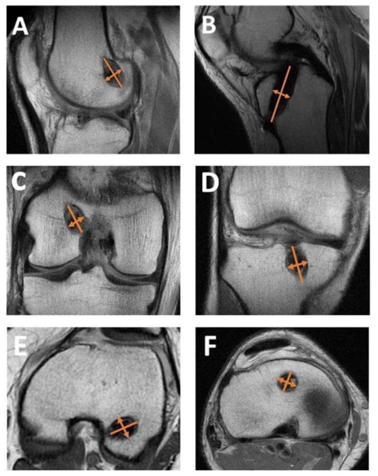 This diagnostic image set consists of six MRI panels (A–F) demonstrating the methodology for measuring femoral and tibial tunnel expansion following Anterior Cruciate Ligament (ACL) reconstruction. Panels A, C, and E show the femoral tunnel in sagittal, coronal, and axial planes, respectively. Panels B, D, and F show the tibial tunnel in sagittal, coronal, and axial planes, respectively. In each plane, the tunnels appear as well-defined, low-signal (dark) cylindrical voids within the cancellous bone of the distal femur and proximal tibia. Orange bidirectional arrows illustrate the quantitative measurement technique, specifically identifying the tunnel diameter perpendicular to the greatest diameter or long axis. This visualization is used to assess post-operative biological complications such as tunnel widening or 'windshield-wiper' effect, which are critical for evaluating graft stability and planning potential revision surgery. The imaging highlights the precise anatomical placement and morphology of the tunnels within the knee joint structures.