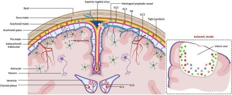 Anatomical and Pathophysiology Diagram illustrating the immunological landscape of the central nervous system (CNS) borders during steady-state and ischemic stroke. The primary cross-section depicts the spatial arrangement of the meninges: the skull, dura mater (containing meningeal lymphatic vessels and superior sagittal sinus), arachnoid mater, arachnoid space with trabeculae, and the pia mater overlying the brain parenchyma. The diagram highlights the distribution of innate lymphoid cells (ILCs), showing NK cells, ILC1, ILC2, and ILC3 residing primarily within the dural meninges. NK-derived IFN-γ is shown diffusing across the tight-junction-restricted arachnoid and pia mater to interact with astrocytes. In the deeper brain, the choroid plexus within the ventricles is shown to harbor ILC1 and ILC2 subsets. An inset titled 'Ischemic stroke' demonstrates the recruitment and accumulation of various ILCs at the border of an infarct core, emphasizing their role in neuroinflammatory responses. The illustration serves as an educational tool for neuroimmunology, detailing the interface between the peripheral immune system and the CNS.