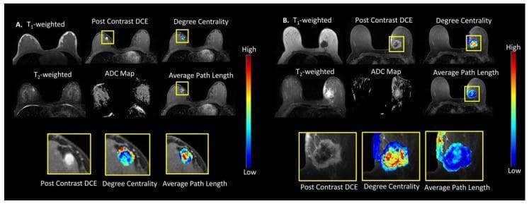 This Comparison Chart illustrates multiparametric breast MRI (mpMRI) and tumor connectomics for a benign vs. malignant lesion. Panel (A) displays a benign fibroadenomatous change in a 27-year-old female, characterized by a small, well-defined lesion with high ADC (1.54 × 10⁻³ mm²/s) and homogeneous signal on T1-weighted and Post-Contrast DCE images. Panel (B) shows an infiltrating ductal carcinoma in a 56-year-old female, featuring a larger, irregular mass with restricted diffusion (ADC 0.68 × 10⁻³ mm²/s) and heterogeneous enhancement. The images include T1-weighted, T2-weighted, Post-Contrast Dynamic Contrast-Enhanced (DCE), and Apparent Diffusion Coefficient (ADC) maps. Integrated Tumor Connectomics Framework (TCF) maps overlay 'Degree Centrality' and 'Average Path Length' metrics using a colorimetric scale (blue = low, red = high). The malignant lesion demonstrates significantly different network topography, with larger, more diffuse areas of varying centrality and altered average path length compared to the focal patterns seen in the benign lesion, highlighting the use of graph theoretic metrics in oncological imaging and diagnostic radiology.