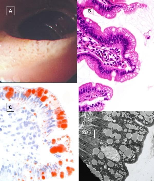 A multi-panel figure illustrating the clinical and histopathological features of a lipid malabsorption disorder, likely Chylomicron Retention Disease or Abetalipoproteinemia. Panel A is a video-endoscopic image of the jejunum showing a characteristic 'white hoary frosting' or white coating on the intestinal mucosa, signifying lipid accumulation. Panel B displays light microscopy of a jejunal biopsy with Hematoxylin and Eosin (H&E) staining, revealing vacuolated enterocytes and preserved villous architecture. Panel C shows the same biopsy stained with Oil Red O, which highlights extensive red-stained neutral lipid droplets specifically localized within the apical cytoplasm of enterocytes at the villous tips. Panel D is an electron micrograph showing the ultrastructural details of an enterocyte, where large, electron-dense lipid droplets and smaller lipoprotein-sized particles are visible within the cytoplasm, confirming defective lipid transport out of the cells. This composite image serves as an educational tool for identifying the diagnostic hallmarks of intestinal fat malabsorption across macroscopic, microscopic, and ultrastructural levels.